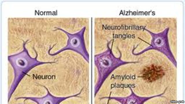 Sëmundja e Alzheimer-it, zbulohet molekula shëruese