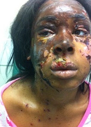 Shpërfytyrimi i vajzës së sulmuar me acid (FOTO)