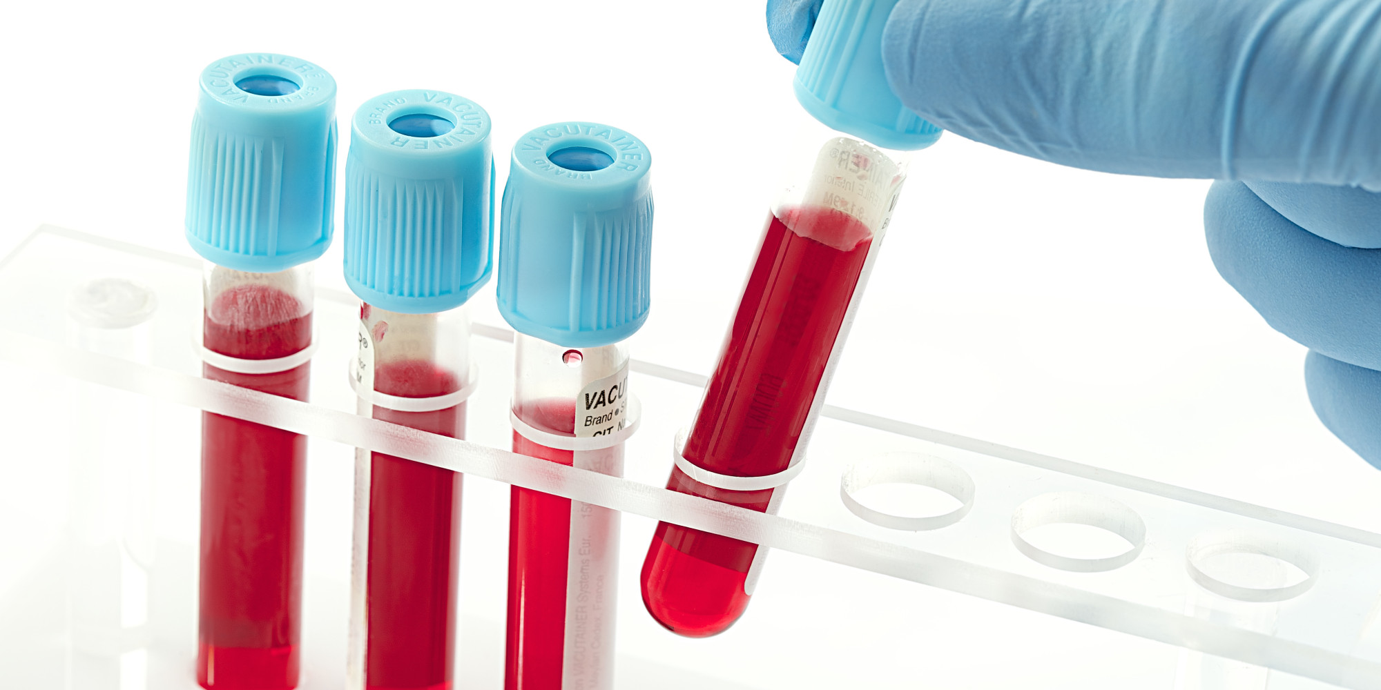Zbulohet testi i gjakut që parashikon vdekjen