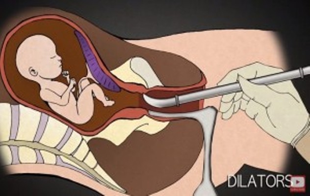 Shihni çfarë pëson nëna e foshnja gjatë abortimit (Video)