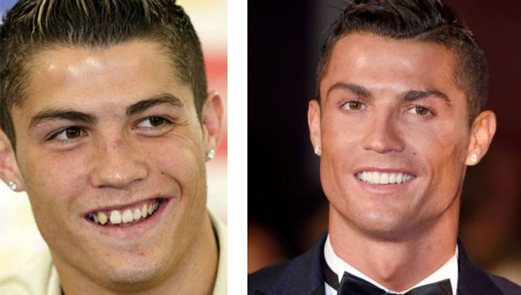 Si ka ndryshuar buzëqeshja e VIP-ave pas famës (FOTO)