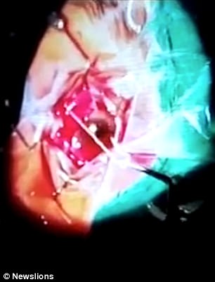 Kishte kruarje në sy, mjekët tmerrohen nga ajo që gjejnë