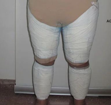 Arrestohet në aeroport, fshehu në trup drogën me vlerë 113 mijë euro