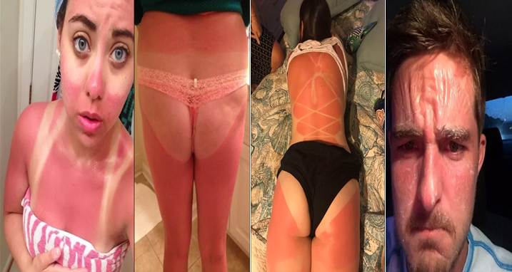 22 njerëz që u përcëlluan keq nga dielli këtë verë