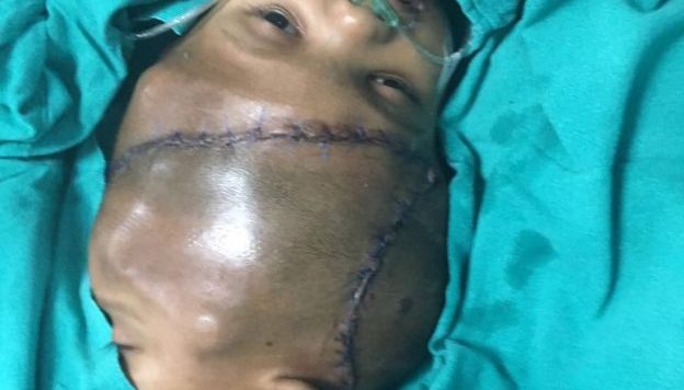 Ndahen binjakët e lidhur në kokë (FOTO)