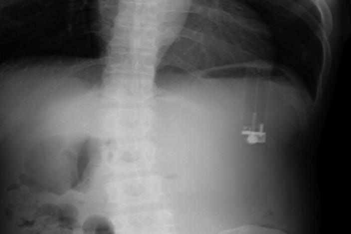 Kishte dhimbje të tmerrshme stomaku, mjekët shokohen nga ajo që zbulojnë