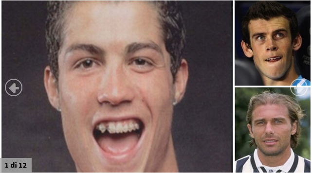 FOTO/ 11 lojtarë para dhe pas operacioneve estetike