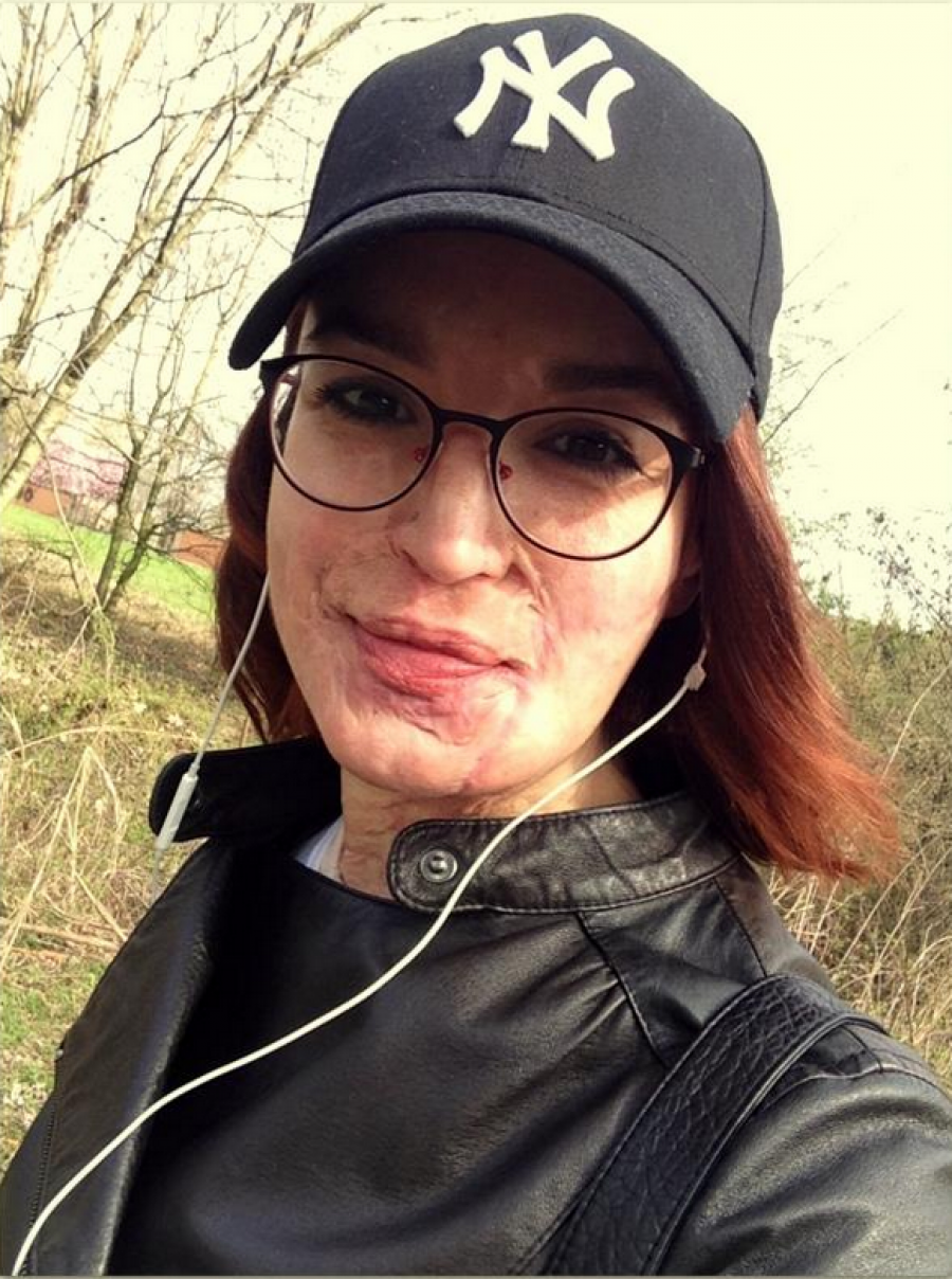 Katër vjet pasi e sulmuan me acid, shikoni transformimin e vajzës (FOTO)