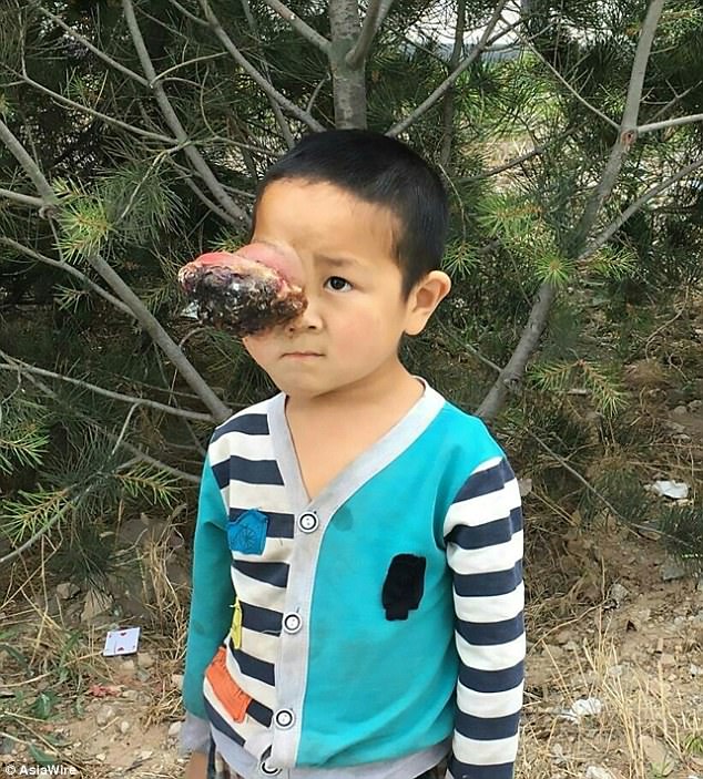 6-vjeçari me tumor në sy shpëton falë ndihmës së fshatit (Pamje të rënda)