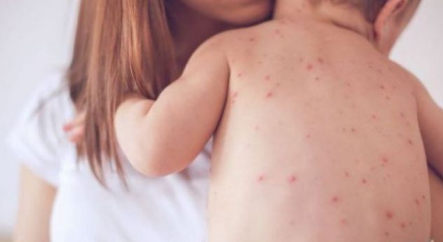 Rishfaqet sëmundja e fruthit në Shqipëri, 11 fëmijë të shtruar në QSUT