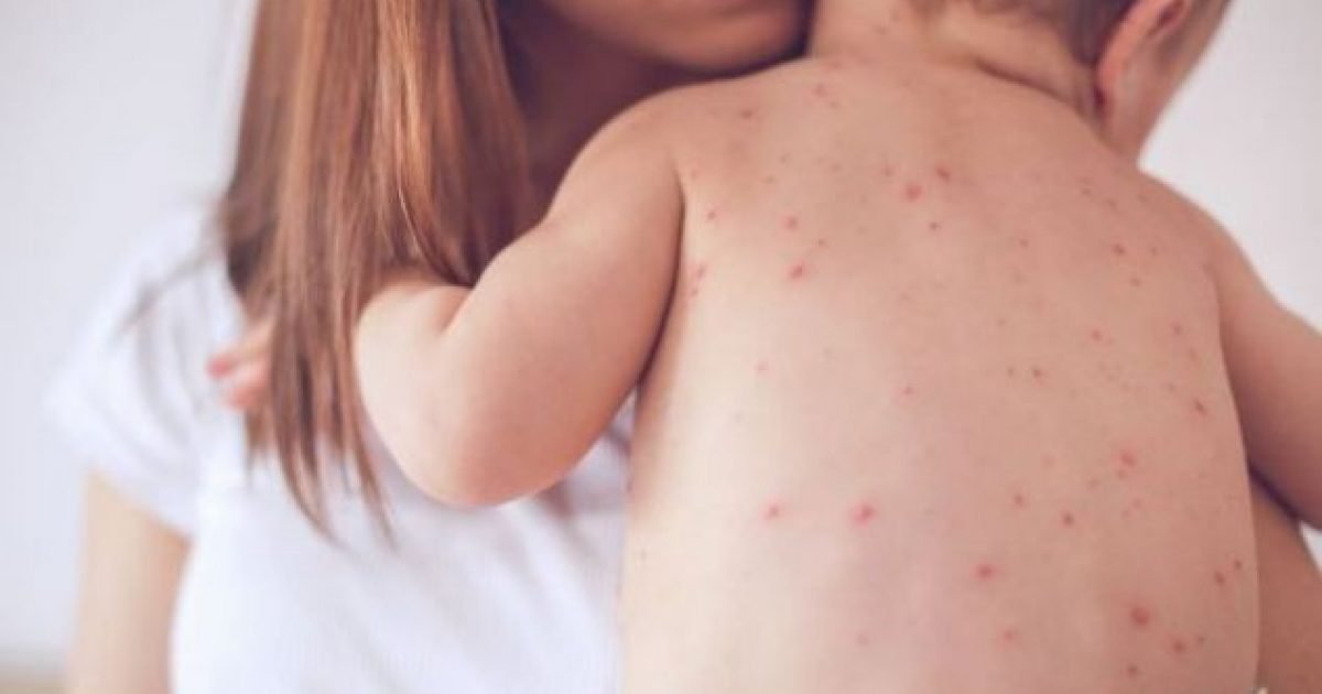 Komplikacione nga fruthi, vdes foshnja 7-muajshe në Pediatri