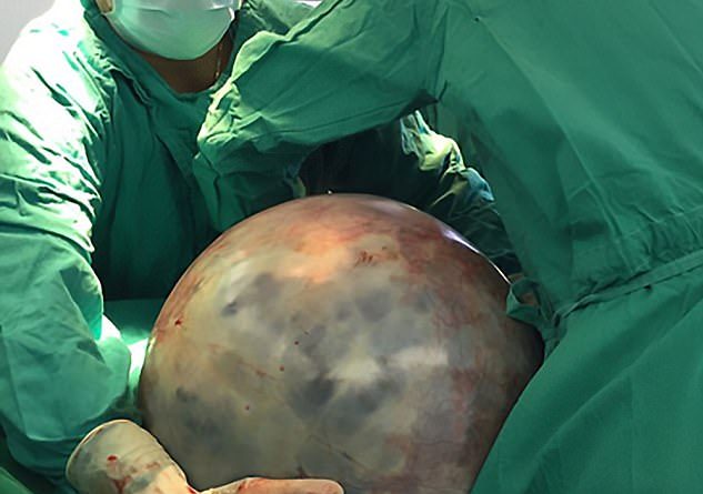 E frikshme/ Gruas i heqin tumorin gjigand, peshonte … 31 kg! (FOTO)