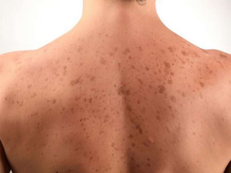 Si të largoni njollat kafe nga fytyra dhe trupi juaj njëherë e mirë!