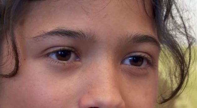 Nuk ka më trishtim në sytë e Dianës! 13 vjeçarja shpëton nga sëmundja e frikshme