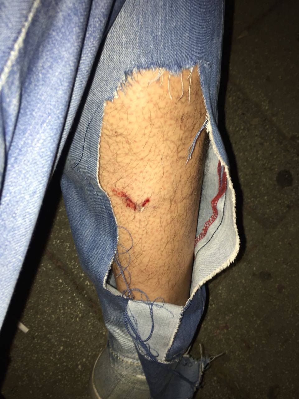 Rast tjetër në Tiranë, 35-vjeçari sulmohet nga 3 qen rruge (FOTO)