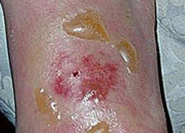 Ekspertët japin alarmin për mizat gjakpirëse, pickojnë nyjet dhe këmbët