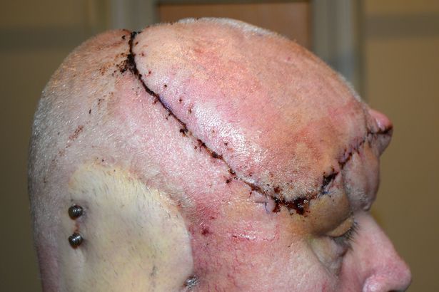 Heq pjesët më të mëdha të kokës pasi luftoi 21 tumore (Pamje të rënda)