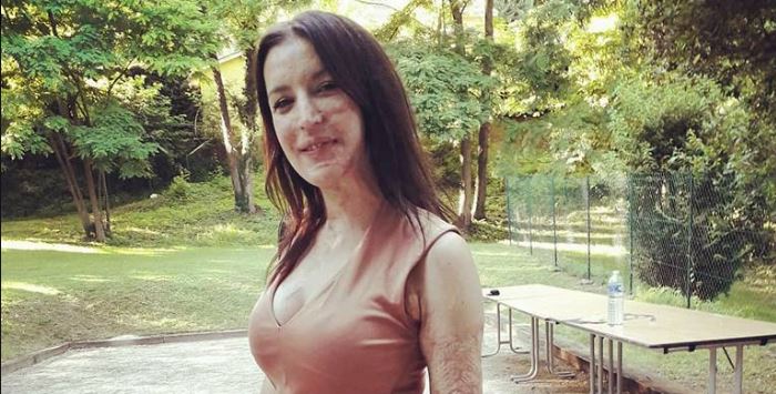 U sulmua me acid, 31-vjeçarja ka një mesazh