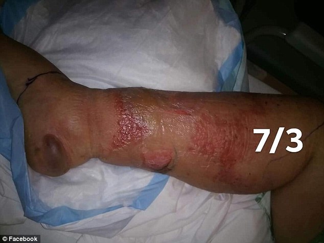 Gruaja për pak humbi këmbën prej shërbimit në qendër estetike (FOTO)