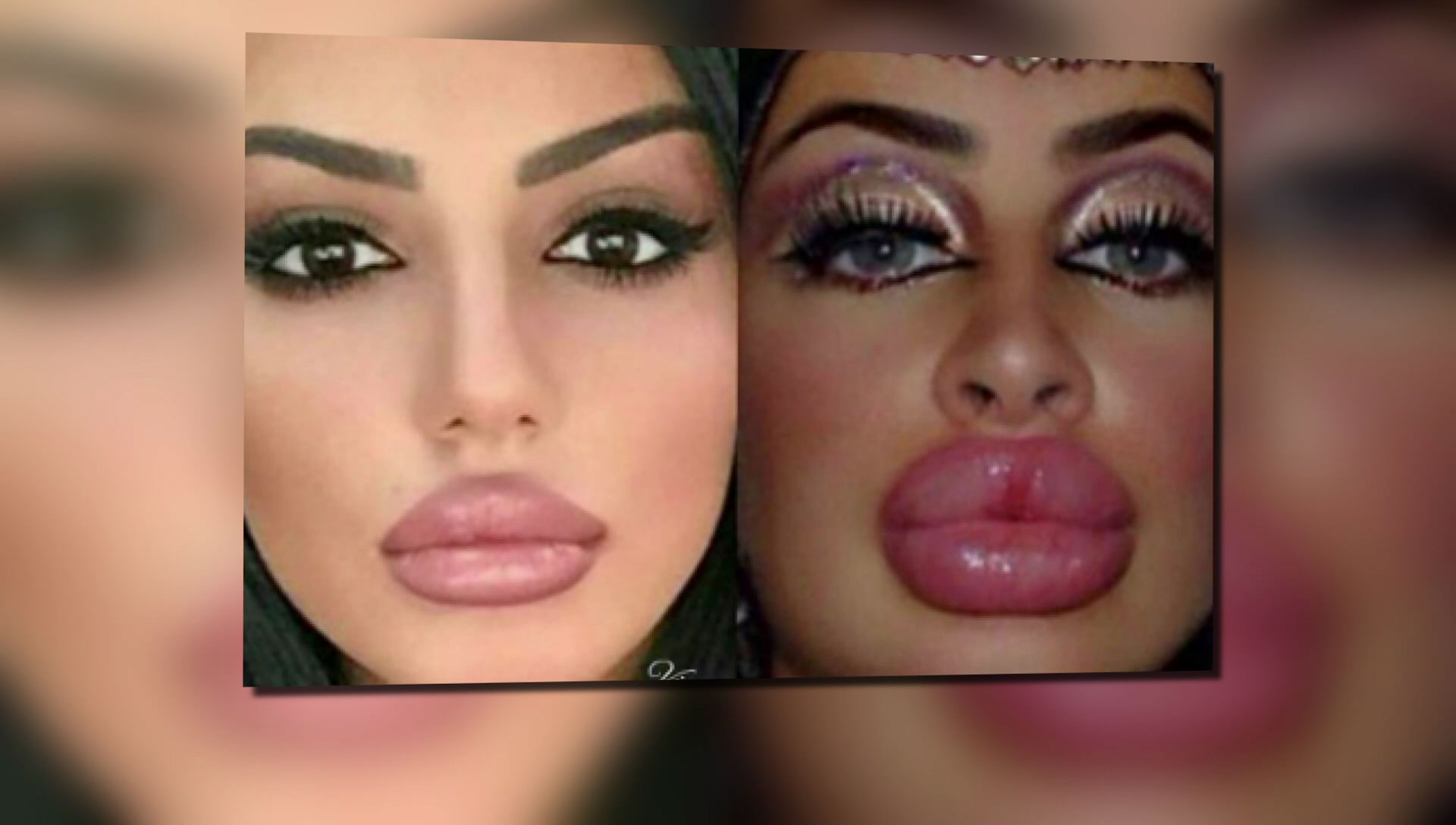 Operacionet plastike, jo vetëm të rinjtë, por edhe 65-vjeçarët shqiptarë