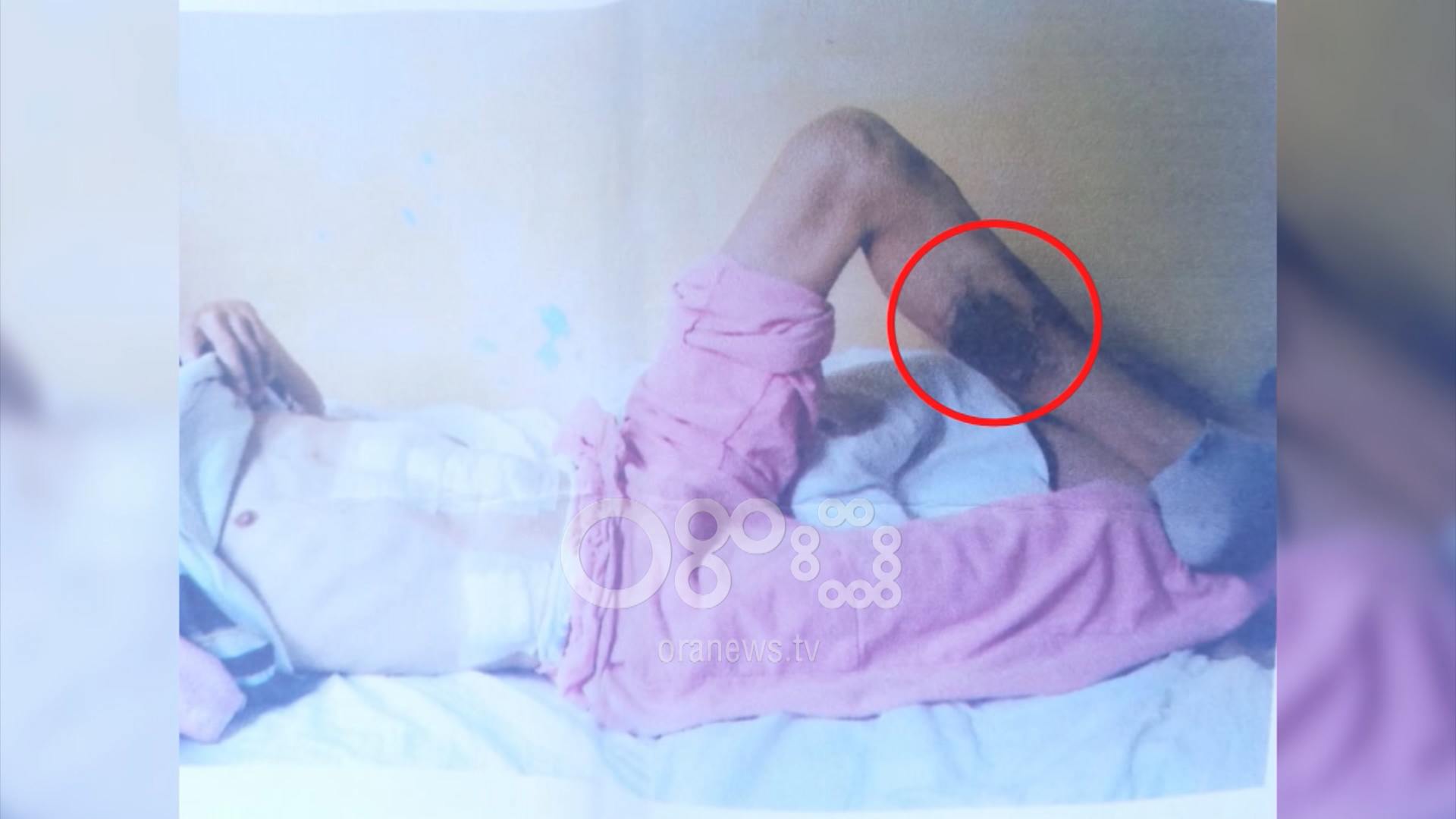 Skandal në spital, pacienti shkon për të operuar stomakun, del i djegur