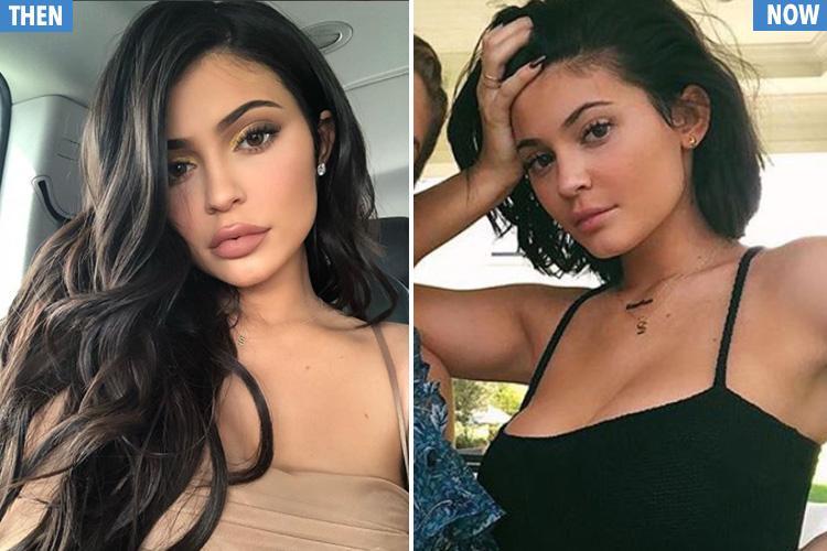 Kylie Jenner heq të gjithë mbushësin për buzët