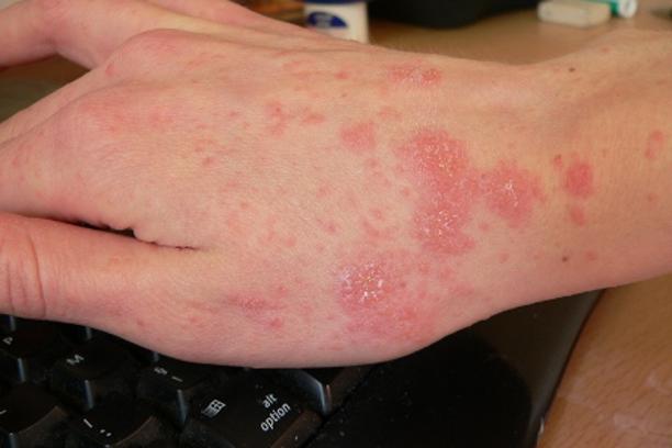 Shtohen dukshëm rastet e infeksionit të zgjebes, mjekja e QSUT: Ja cilat janë simptomat