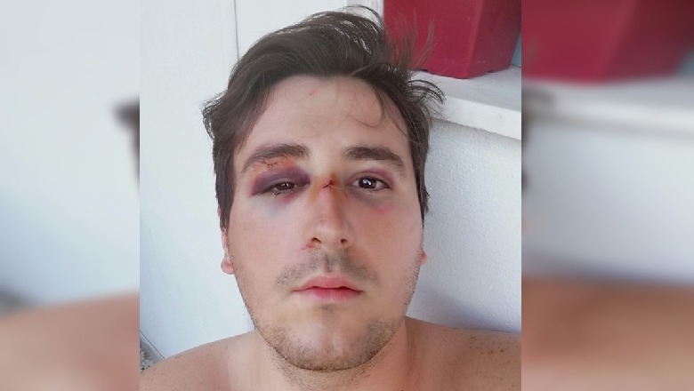 Ndërhyri për të ndihmuar një grua, dhunohet me dorezë hekuri ish-nënkryetari i FRESSH-it