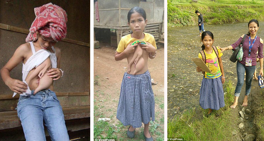 Vajza me krah e gishta në pjesën e barkut (KUJDES: Pamje të rënda)