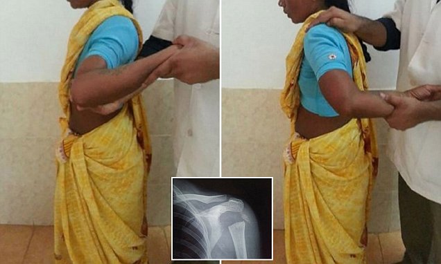 Rrotullon krahun 180 gradë, gruaja preket nga sëmundja e rrallë