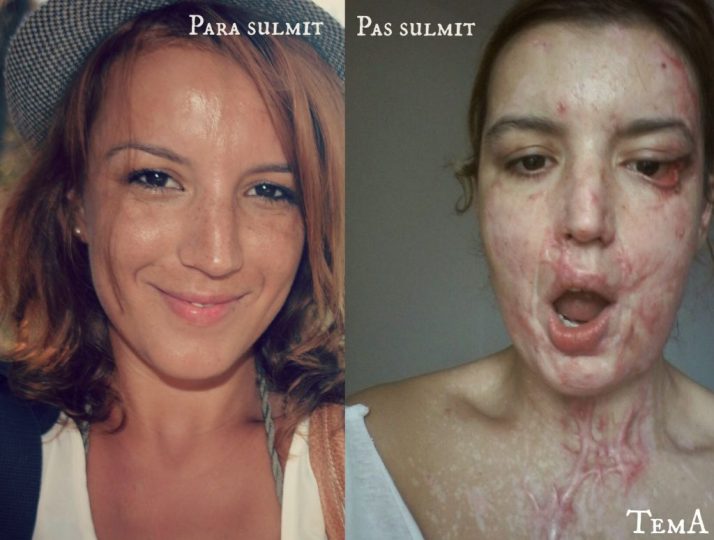 “Buzëqeshja që mposhti acidin”, Vilma Dule rrëfehet për herë të parë pas pesë vjetësh nga sulmi me acid