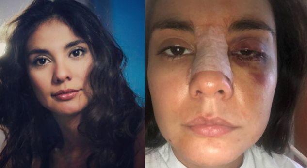 Aktorja e njohur rrihet brutalisht nga i dashuri