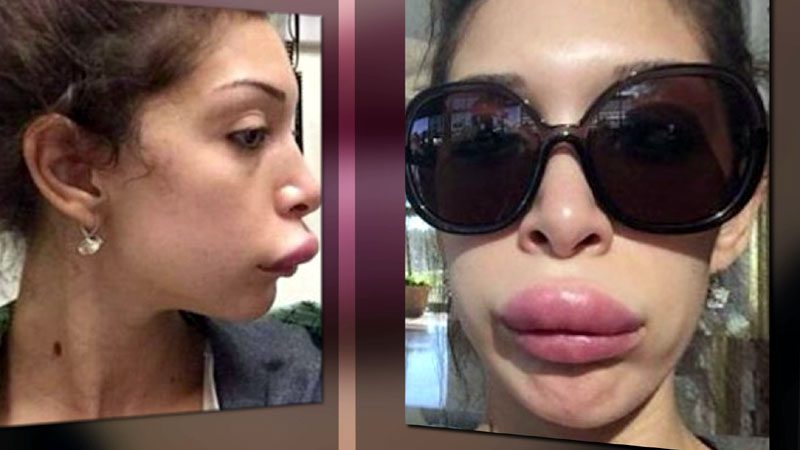 Rreziku i ndërhyrjeve estetike. Mjekët dermatologë: Shqiptarët, të ekspozuar nga sëmundjet