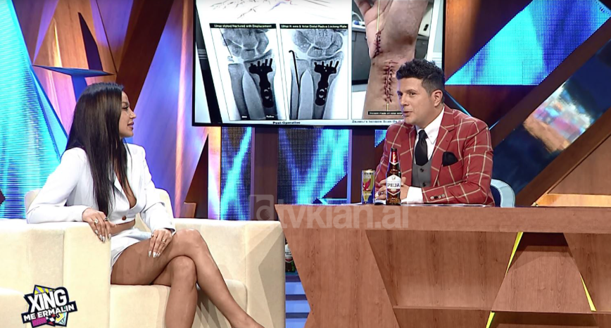 U rrëzua dhe theu dorën, modelja: Mora një kompesim shumë të madh, ia ka vlejtur