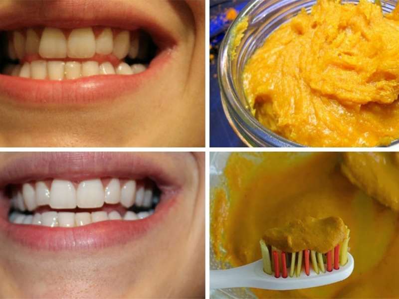 Zbardhni dhëmbët në shtëpi në pak minuta, si ta përdorni këtë “pastë”