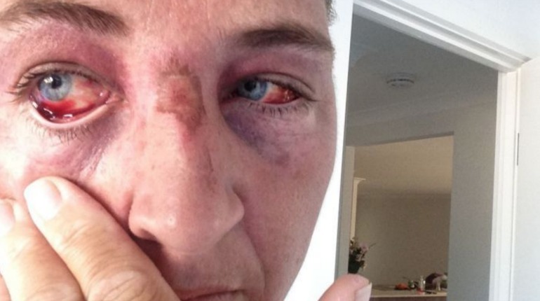 Tentoi të largonte pitonin nga pema, gruaja rrëfen tmerrin që përjetoi