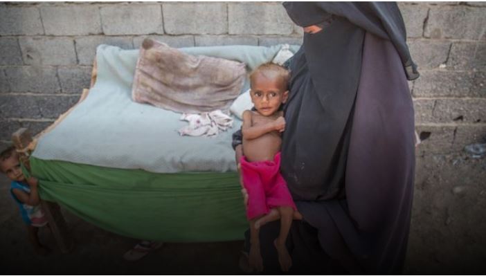 85,000 fëmijë humbin jetën nga kequshqyerja në Jemen