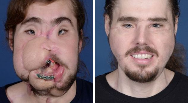 “Mund të buzëqesh sërish!” I riu transformohet pas transplantit të fytyrës