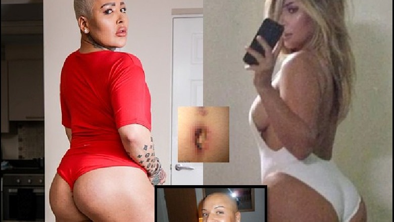 Donte të pasme si të Kim Kardashian, 27-vjeçarit i rrezikohet jeta