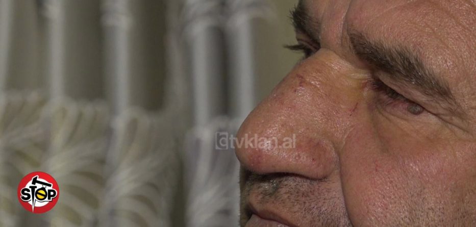 Tullë në ballë e brinjë të thyer, pronari i parkimit dhunohet barbarisht