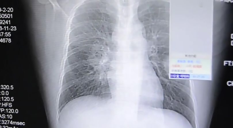 Vesi i pazakontë i shkakton infeksion në mushkëri