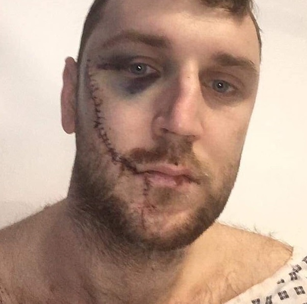 Ja si u shpërfytyrua me thikë tifozi i Evertonit