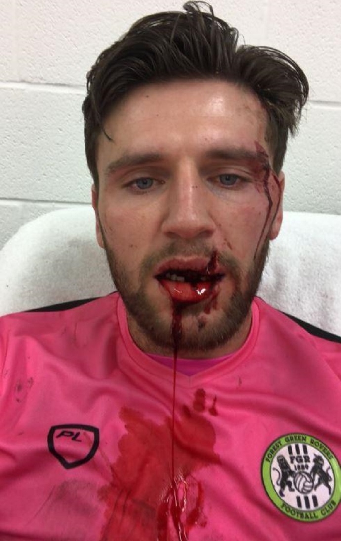 Portieri zbulon dëmtimin e tmerrshëm, kërkon ndihmë për… dhëmbët e rinj