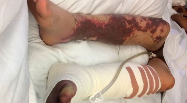 E menduan helmim ushqimi, 14-vjeçari humb njërën këmbë (FOTO)