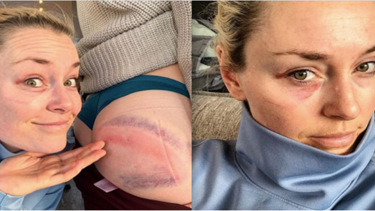 Vonn tregon të pasmet e rivales: Kush e di ç’ngjyrë do të kenë nesër