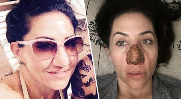 Gjithçka nisi me një skuqje, i zhvillohet infeksioni i rrallë në hundë