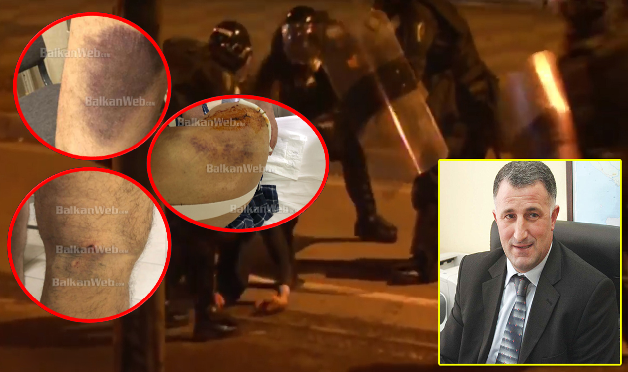 Me qepje në shpatull dhe të nxira në trup shfaqet Sahit Dollapi pas rrahjes barbare (FOTO)