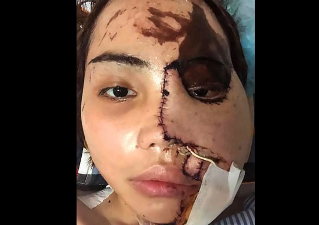 Zjarrfikësi sulmon me acid të fejuarën e tij