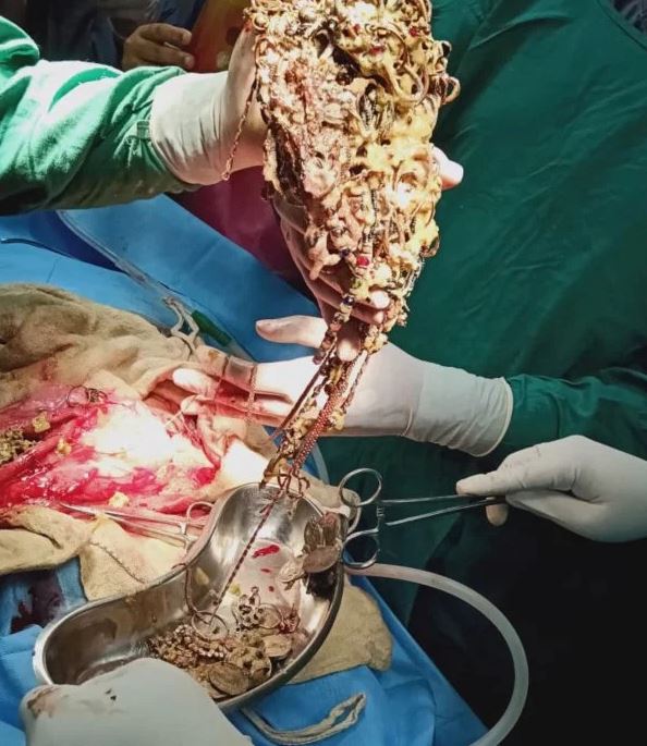 E reja shkon në spital me dhimbje të forta barku, mjekët i gjejnë një “thesar” të vërtetë (FOTO)