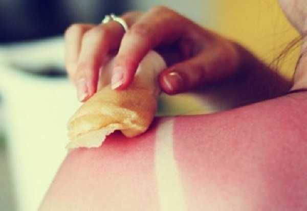 Si të trajtoni të djegurën nga dielli shpejt në vetëm dy hapa